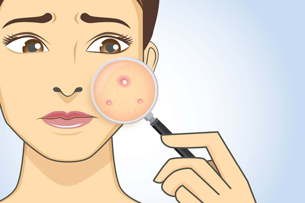 Por que algumas pessoas têm espinhas e outras não?