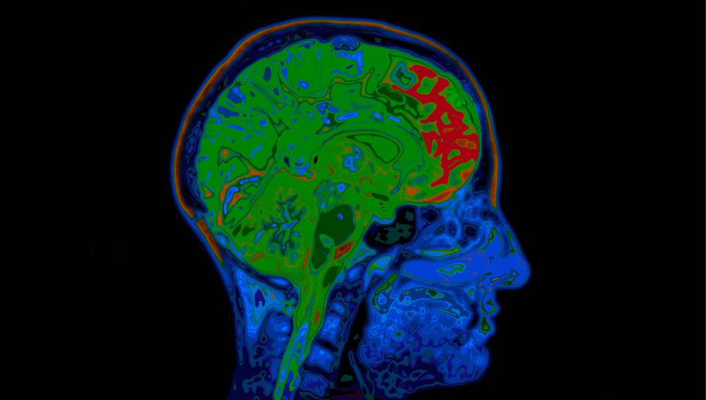 Bug em software de ressonância magnética pode invalidar 15 anos de pesquisas sobre o cérebro