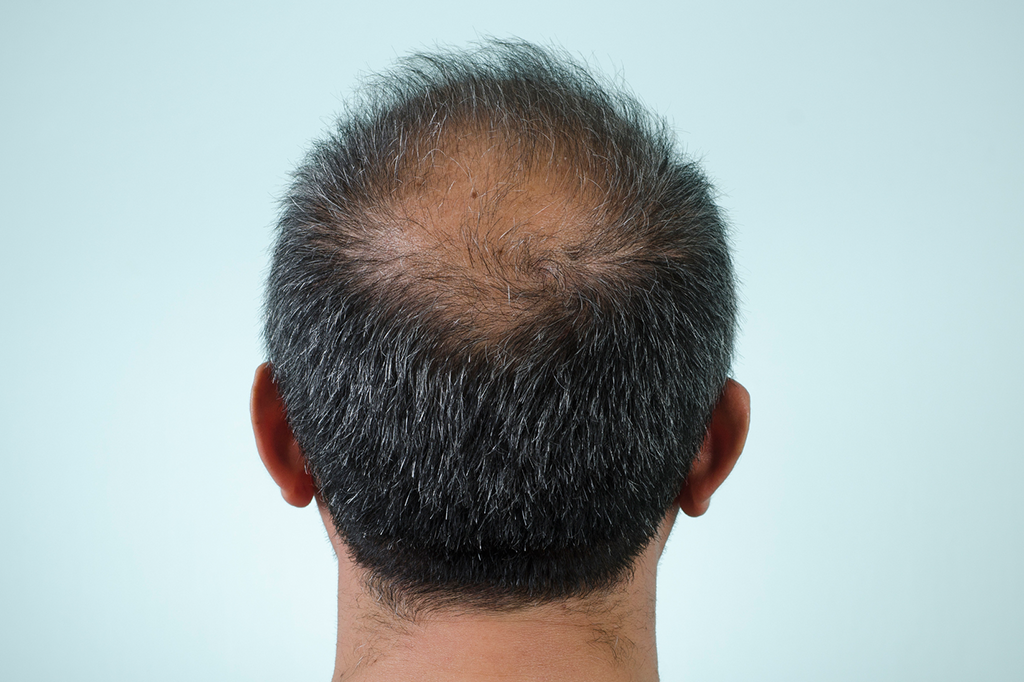 Criado novo tratamento para calvície que utiliza células-tronco