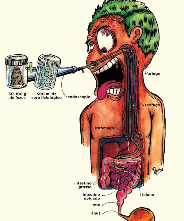 transplante