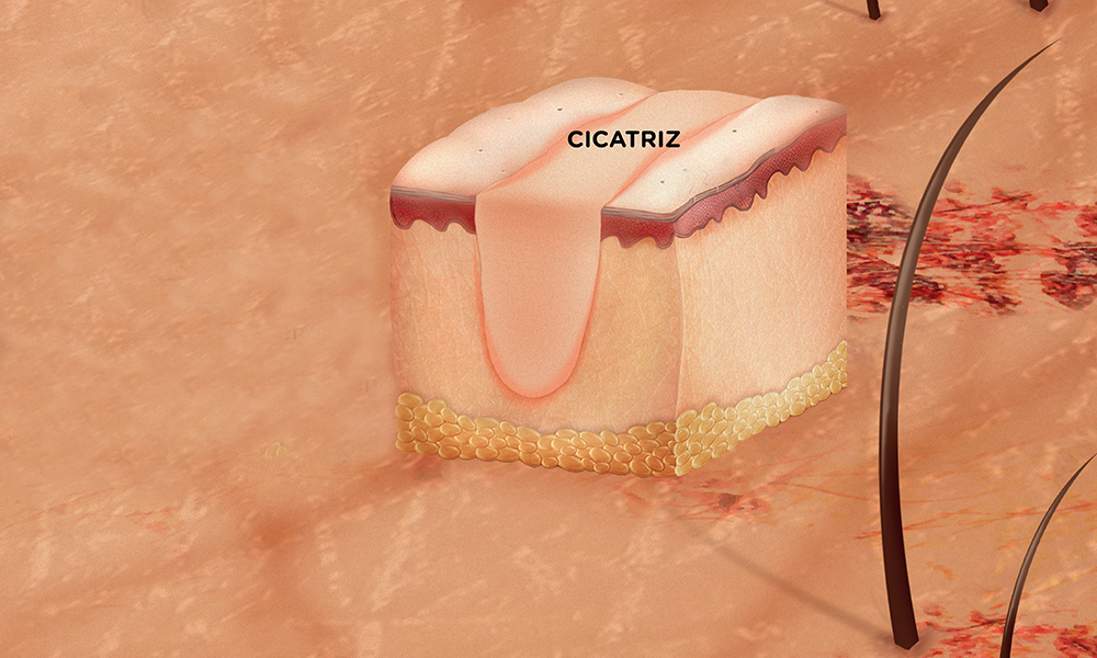 cicatriz