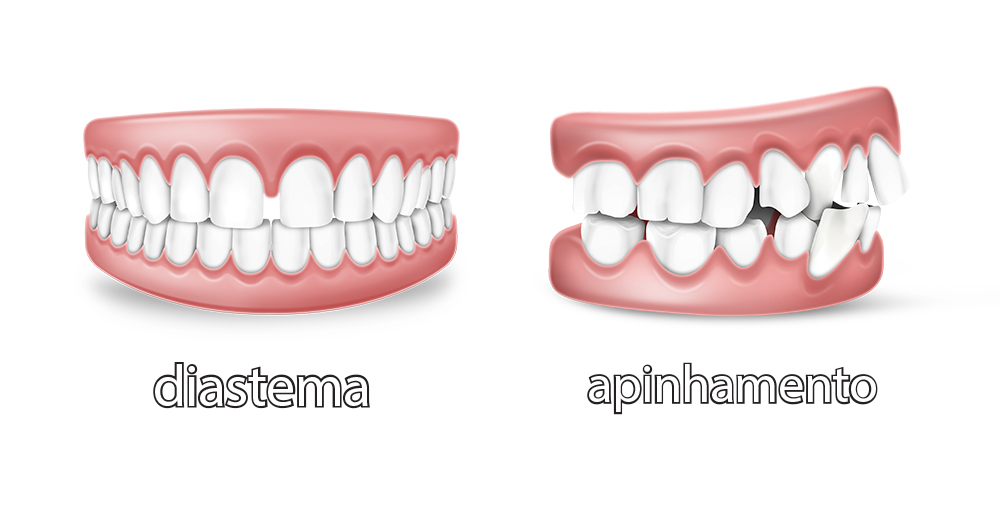 Como os aparelhos corrigem os dentes das pessoas?