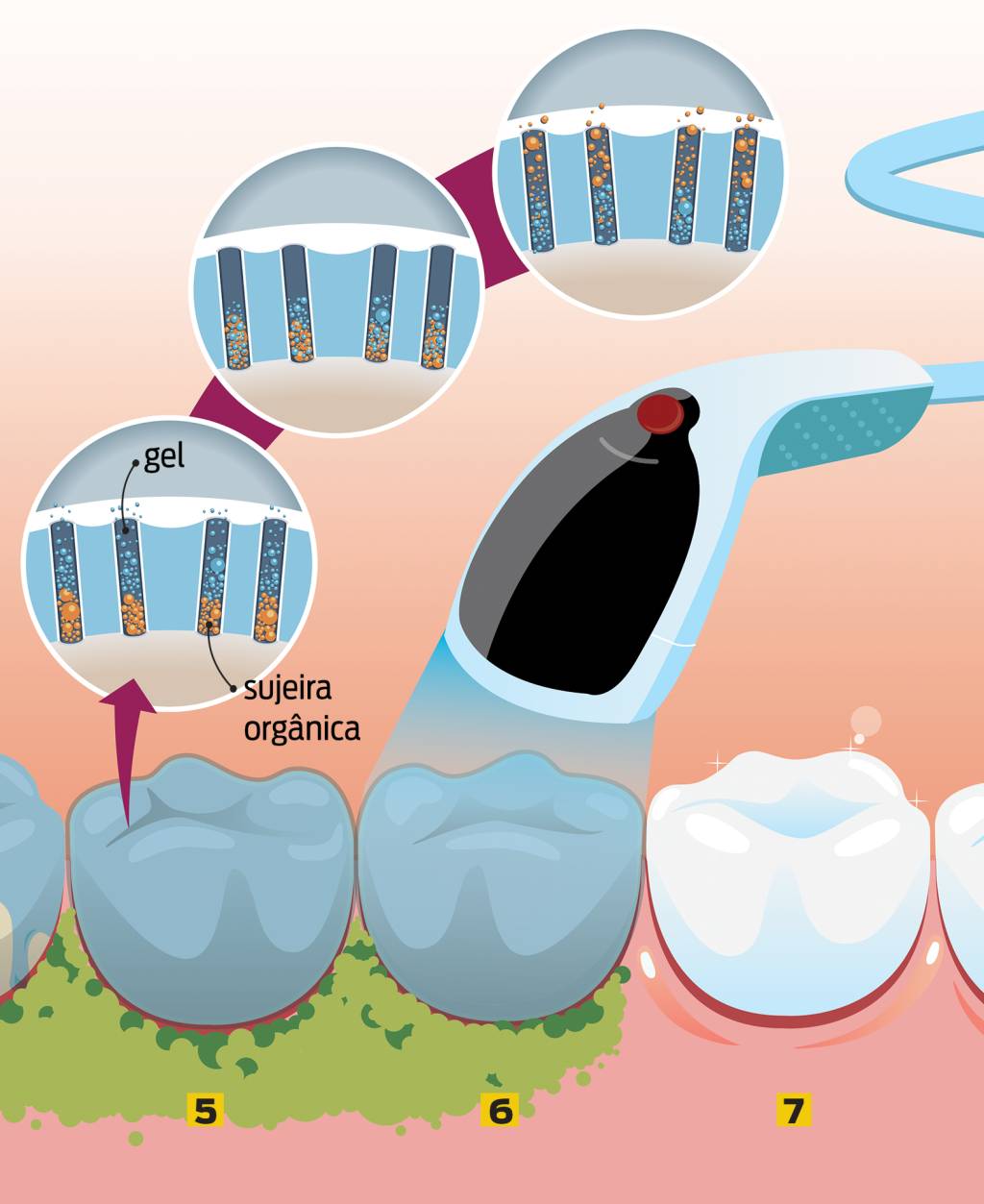 Como é feito o clareamento dental?