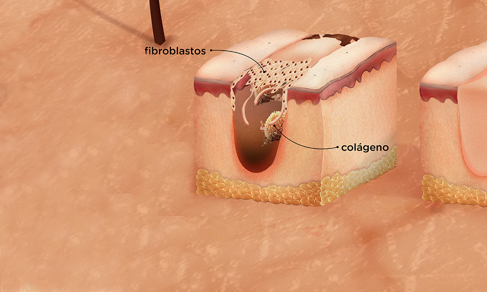 Como se forma a casca de ferida?