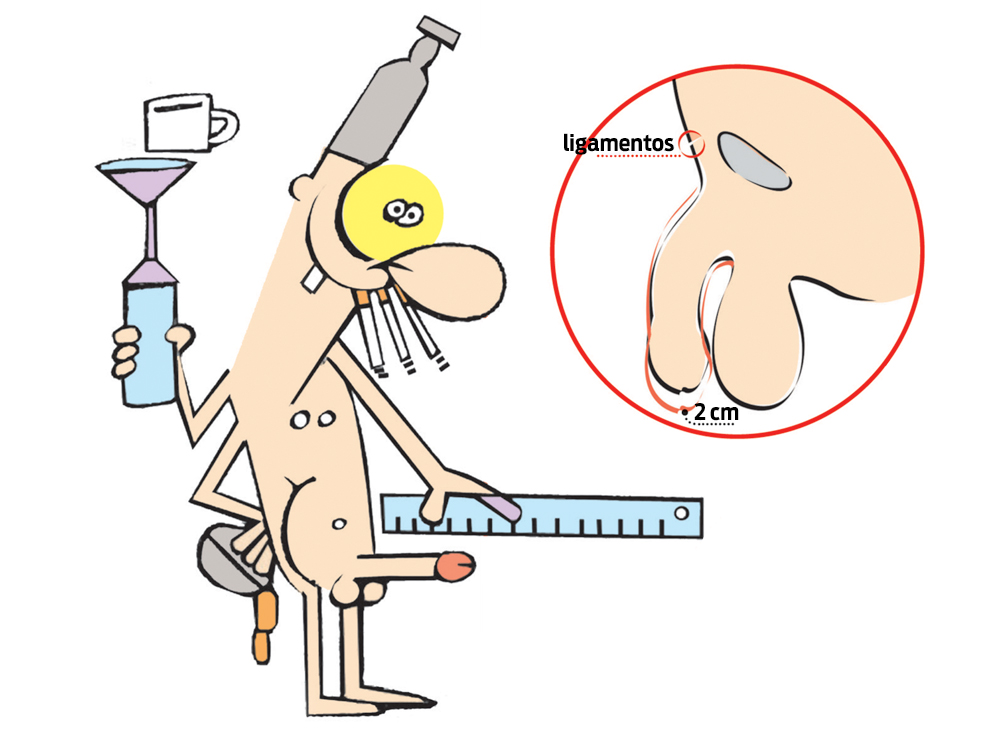 Existe cirurgia para aumentar o tamanho do pênis?