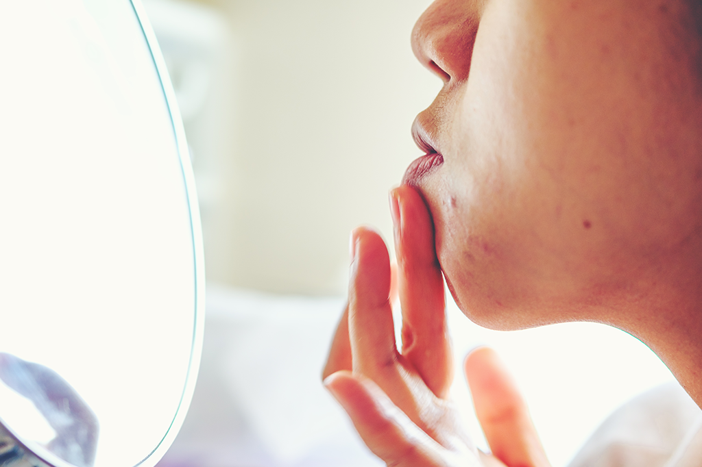 Estudo identifica novo fator genético determinante para acne