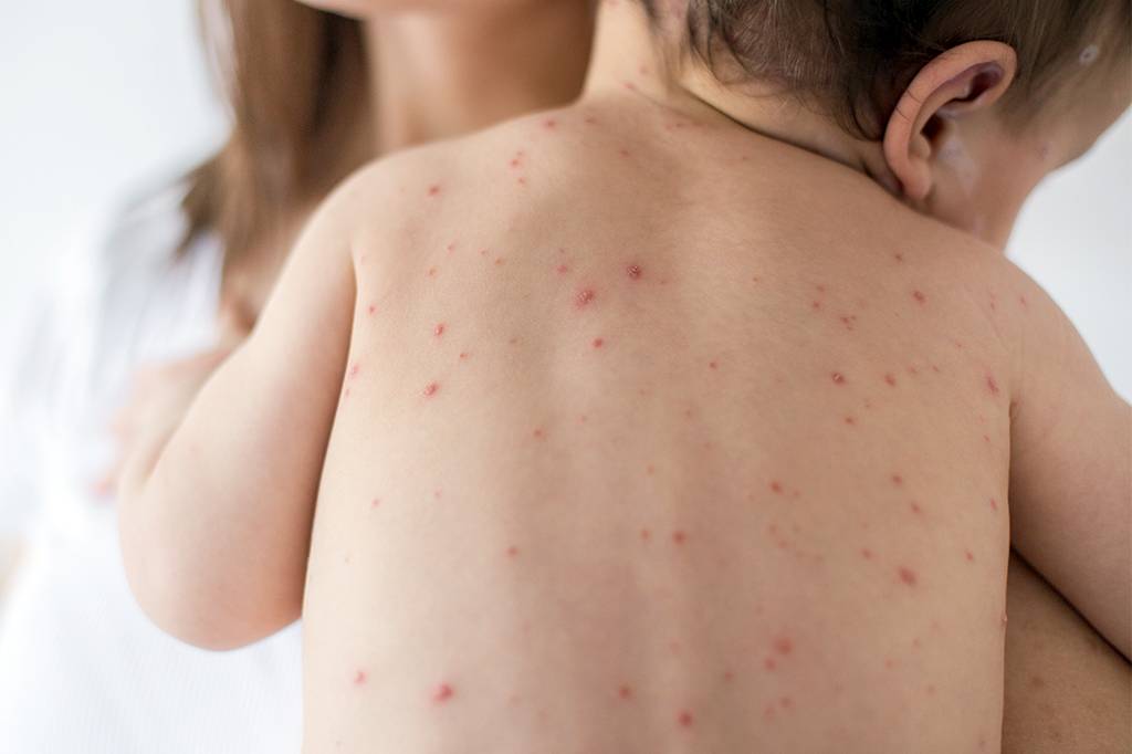 Sarampo é tão contagioso quanto gripe – e a vacina é a única forma de prevenção