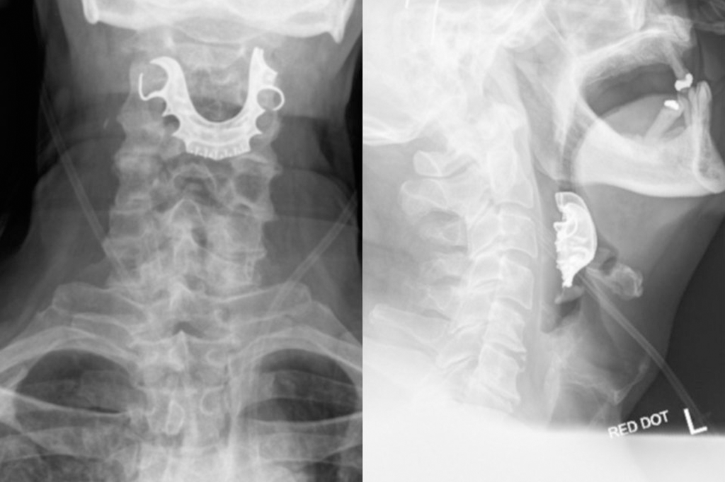 Idoso engoliu sua dentadura durante cirurgia – e ela entalou na garganta