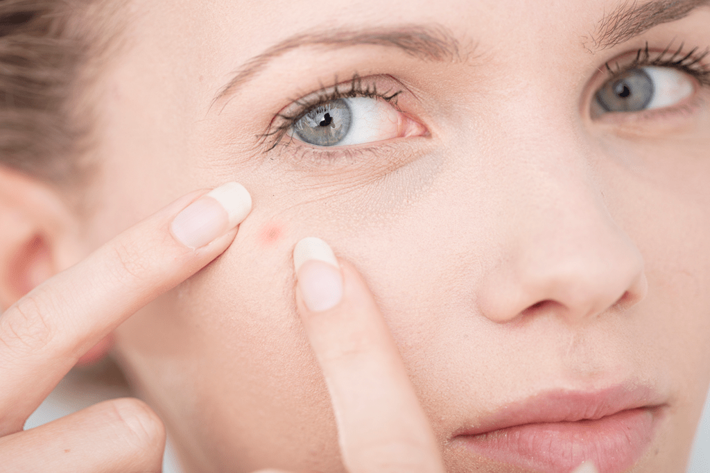 Existem diferenças entre a acne adolescente e a acne adulta – saiba quais