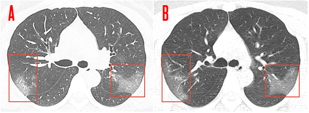 SI_raiox_corona_pneumonia SI_raiox_corona_pneumonia