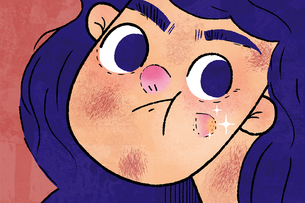 Bactéria da acne produz antibiótico que afasta micróbios