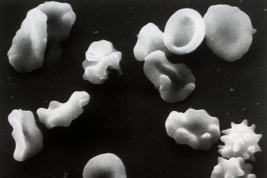 Glóbulos vermelhos deformados por anemia falciforme.