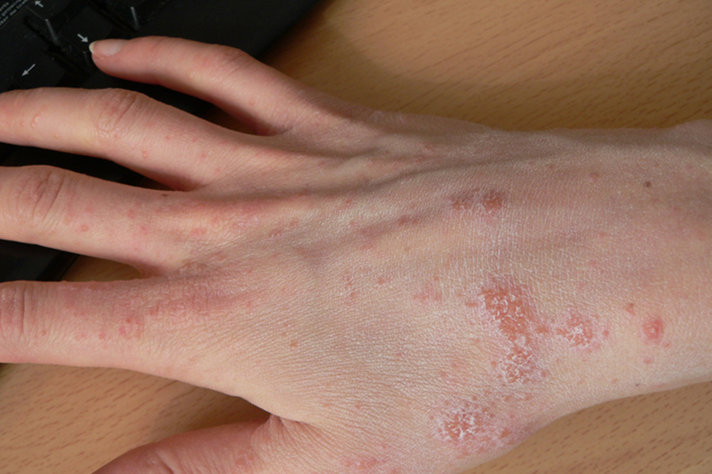 Mariposas causaram surto de coceira em Pernambuco, afirmam dermatologistas