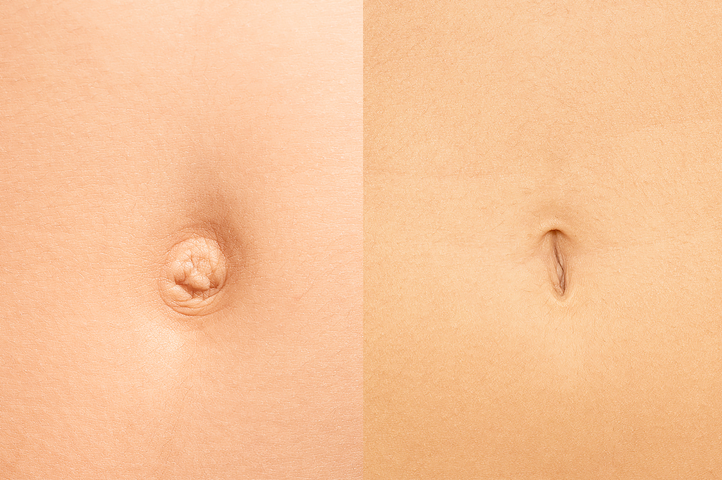 Por que algumas pessoas têm o umbigo para fora e outras para dentro?