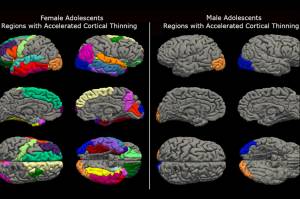 1009-efeito-covid-cerebro As varreduras cerebrais revelam um adelgaçamento acelerado do córtex em adolescentes que sobreviveram à pandemia de Covid.