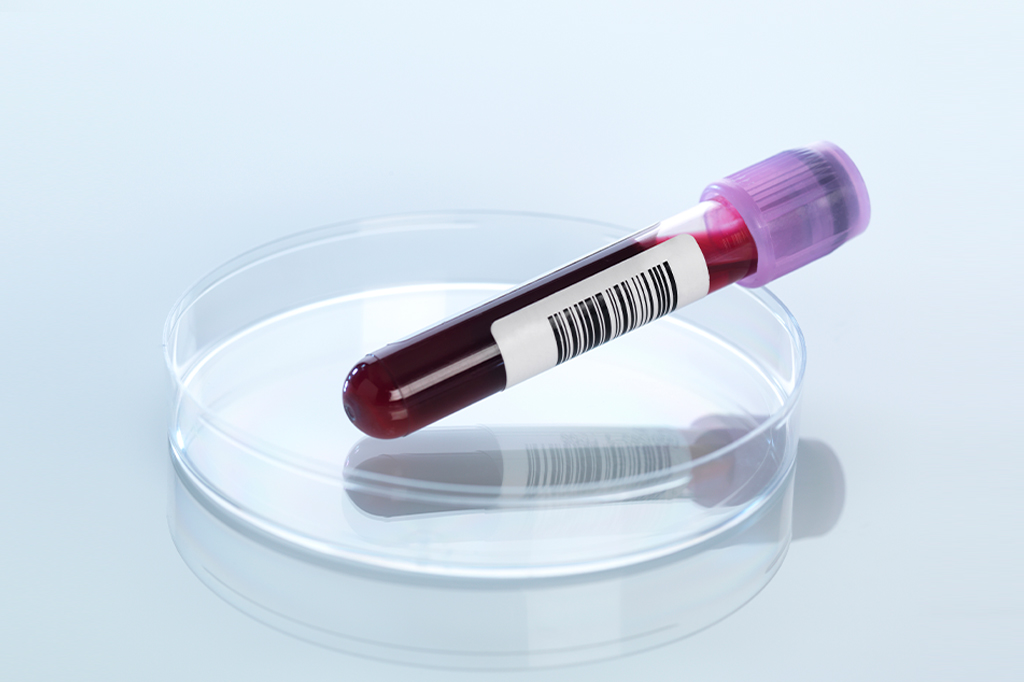 Foto de amostra de sangue em placa de Petri.