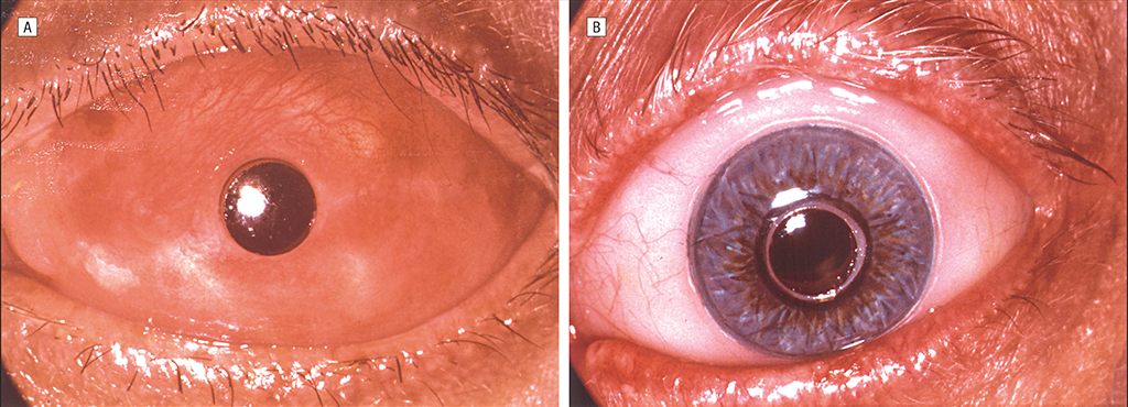 1103-olhos-layout_site Imagem A, Resultado final 3 meses após a cirurgia. B, Prótese cosmética cobrindo a superfície ocular externa.