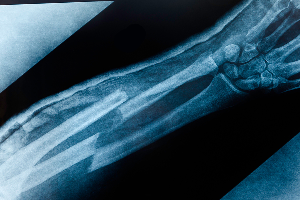 Cientistas testam “pistola de cola quente” para reparar ossos quebrados