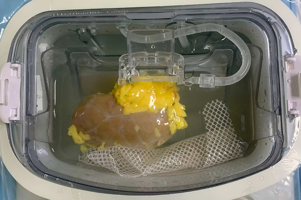 Pela primeira vez, médicos transplantam rim com tipo sanguíneo modificado